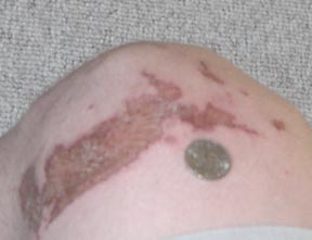 Burnt Knee.jpg - 16kB