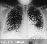 Mercury-Lungs.jpg - 83kB